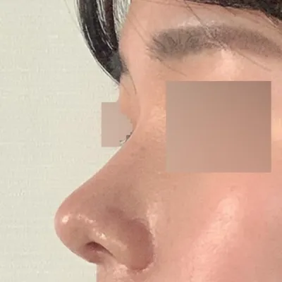 ウィーバース美容外科で目と鼻の手術を受けて1ヶ月後のレビュー!!