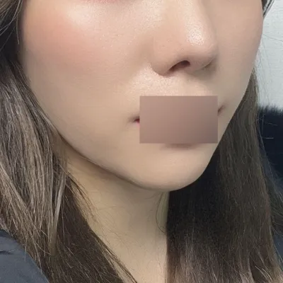 ピーチシルリフティング3ヶ月目になりました