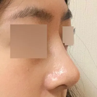 ソ・スンジョ先生に手術を受けた1ヶ月目のレビューです。