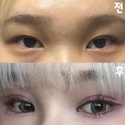 手術に大満足です。皆さん、ウィーバースで手術しましょう!!