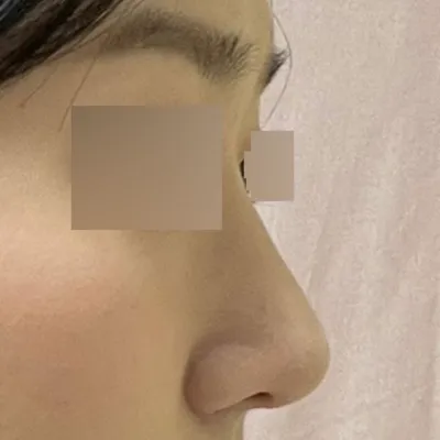 新しい鼻を作っていただき、とても気に入っています(笑)