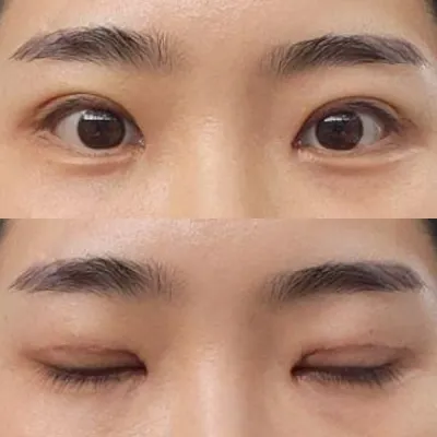 目の再手術を受けてから一週間経ちました