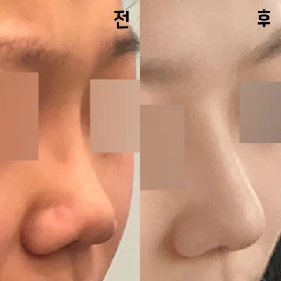 私もついに憧れの鼻を手に入れたみたい！！