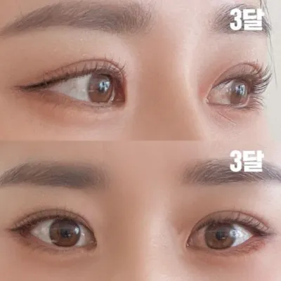 私が望むスタイルで手術を上手にしてくれました!!