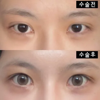 ウィーバース美容外科で手術して2ヶ月目です〜