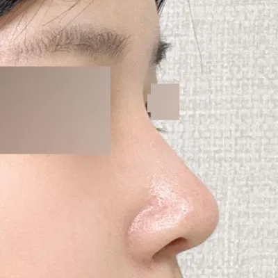 ウィーバーズ整形外科で手術してから2ヶ月目の日です〜