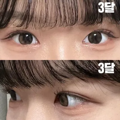 シム・ジョンファン院長にインアウトラインで手術してもらいました。