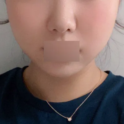 シム・ジョンファン院長に糸リフトをしてもらって1ヶ月経ちました