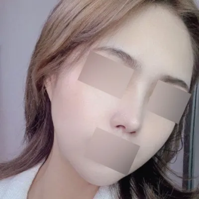 リフティング+鼻再手術4ヶ月目のレビューです