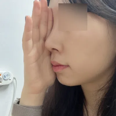 鼻の手術後3週間のレビューです :)