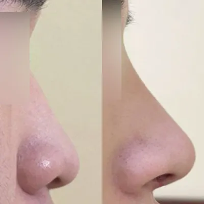 低くて垂れた鼻の手術レビュー