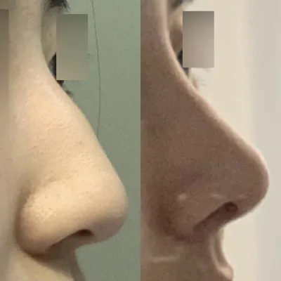 ワシ鼻の手術を受けましたㅎㅎ