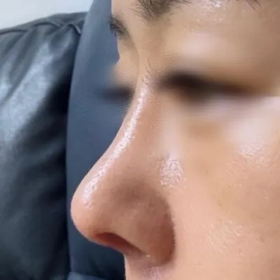 鼻先が垂れ下がっているのが悩みでしたが、鼻先ができてとても嬉しいです^^