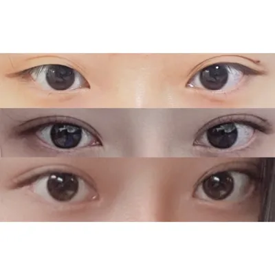 目と鼻の手術を受けましたㅎㅎ