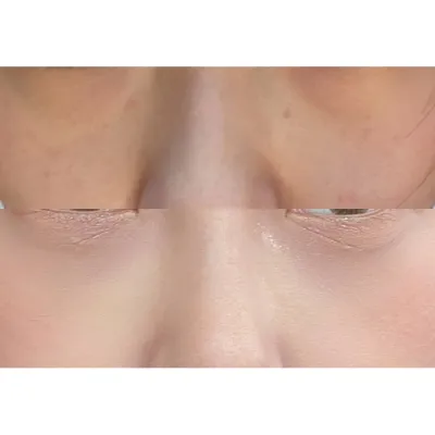 疲れて見える目の下の脂肪を改善しましたㅎ