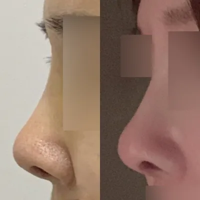 5年前に突然鼻の手術をしました:-)))