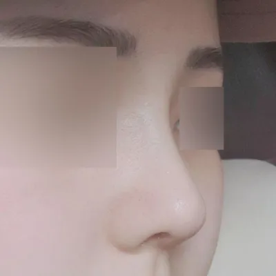 鼻の手術から1ヶ月