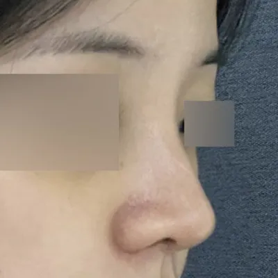 手術して2週間目です