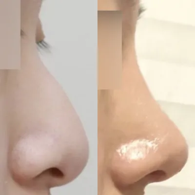 初めての鼻の手術をプロテーゼなしで受けました！