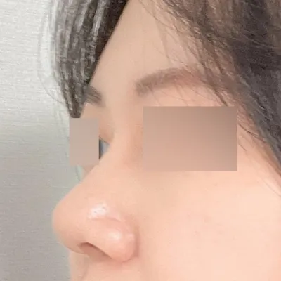 手術3ヶ月目のレビュー