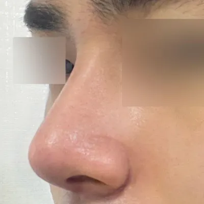 ウィーバース美容外科で手術を受けてから2週間目です。