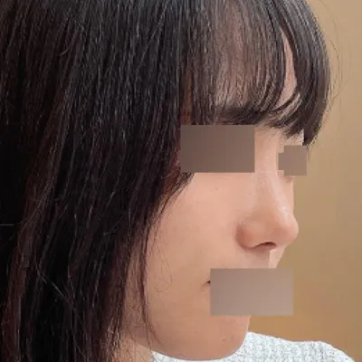 団子鼻手術後3ヶ月